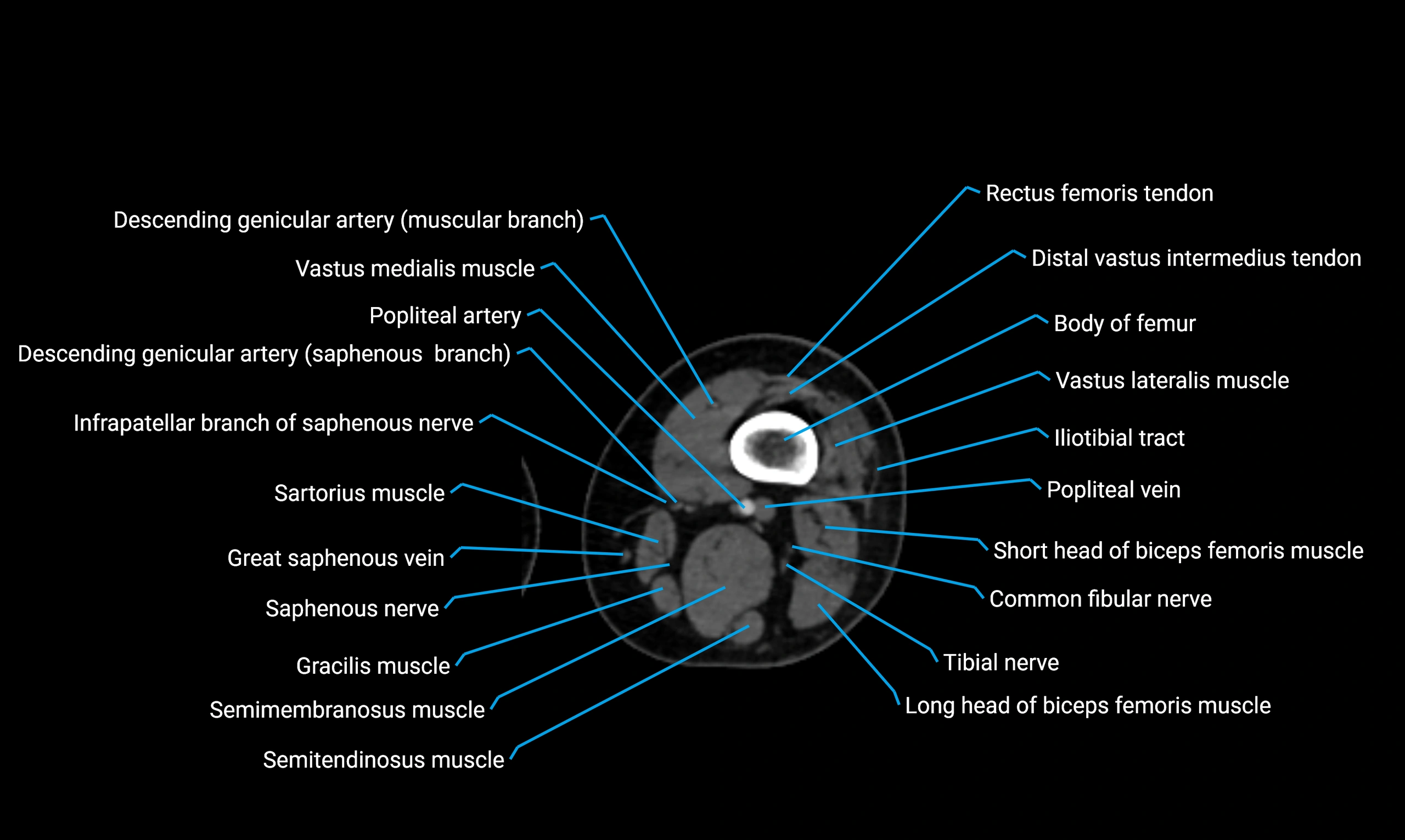 CT thigh axial cross sectional anatomy labelled image_71 (2).webp
